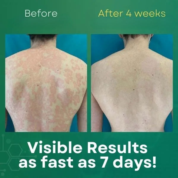 Psoriasis Treatment Cream (Orignal)