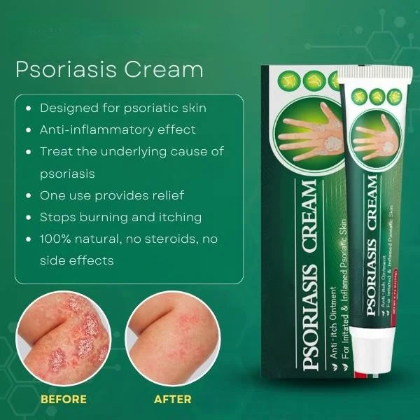 Psoriasis Treatment Cream (Orignal)
